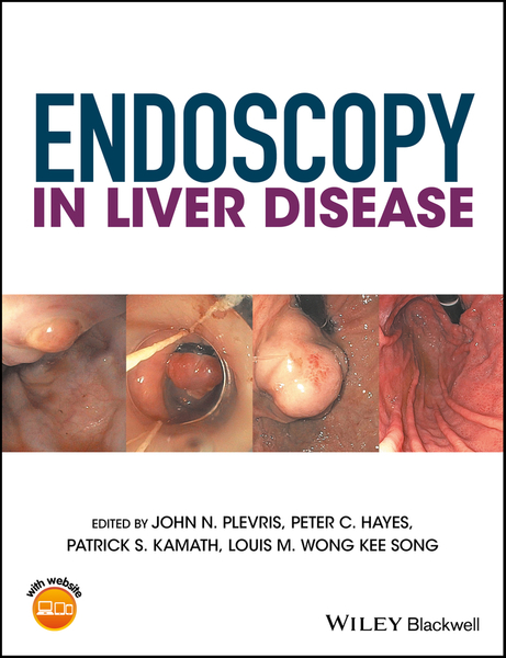 Endoscopy in Liver Disease