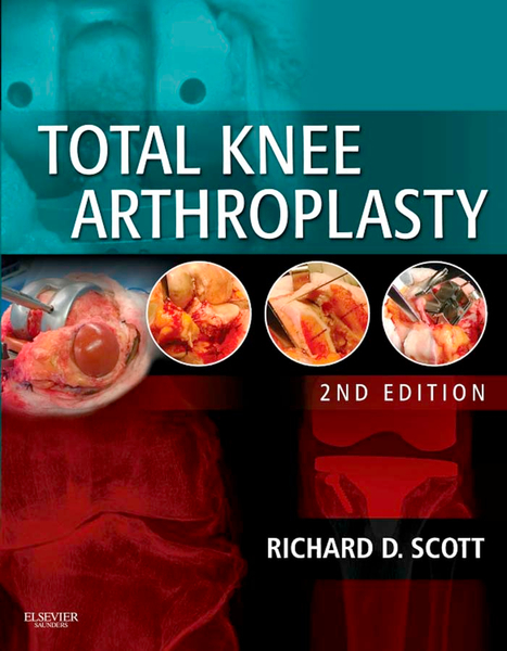 Total Knee Arthroplasty E-Book