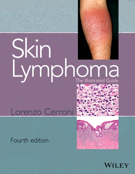 Skin Lymphoma