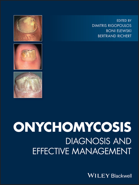 Onychomycosis