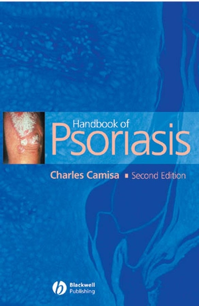 Handbook of Psoriasis