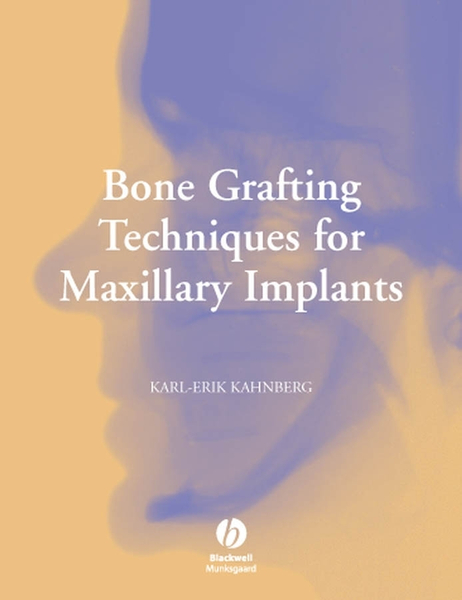 Bone Grafting Techniques for Maxillary Implants