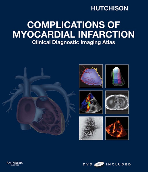 Complications of Myocardial Infarction E-Book