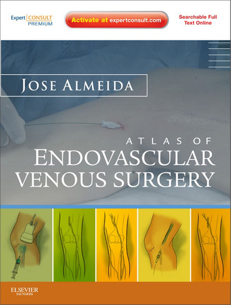 Atlas of Endovascular Venous Surgery E-Book